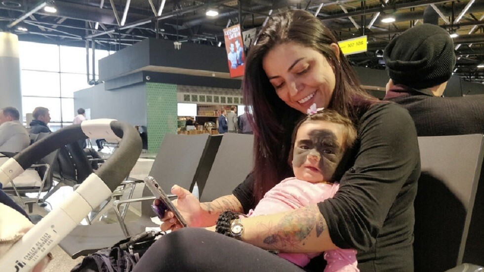 الأطباء الروس يتمكنون من إزالة وحمة 