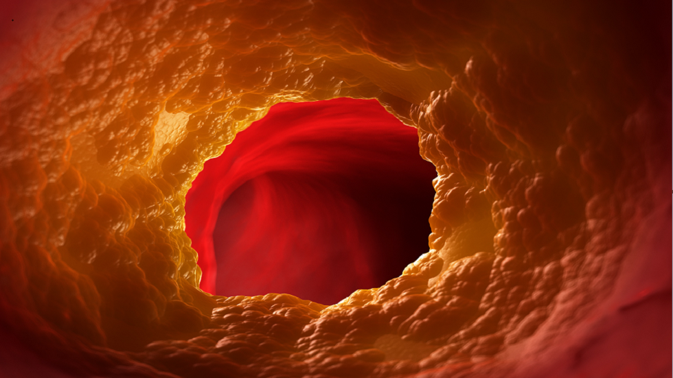 ارتفاع نسبة الكوليسترول: شعور في ذراعيك قد يدل على انسداد الشرايين!