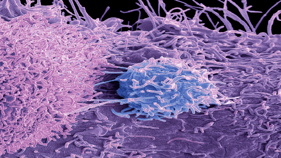 سرطان البروستات: الأعراض البولية السبعة المرتبطة بالحالة!