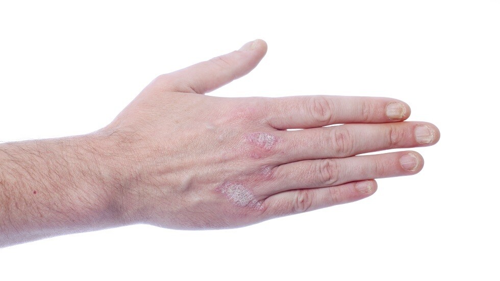 كشف أكثر العلامات الجلدية انتشارا عند الإصابة بمتحور 