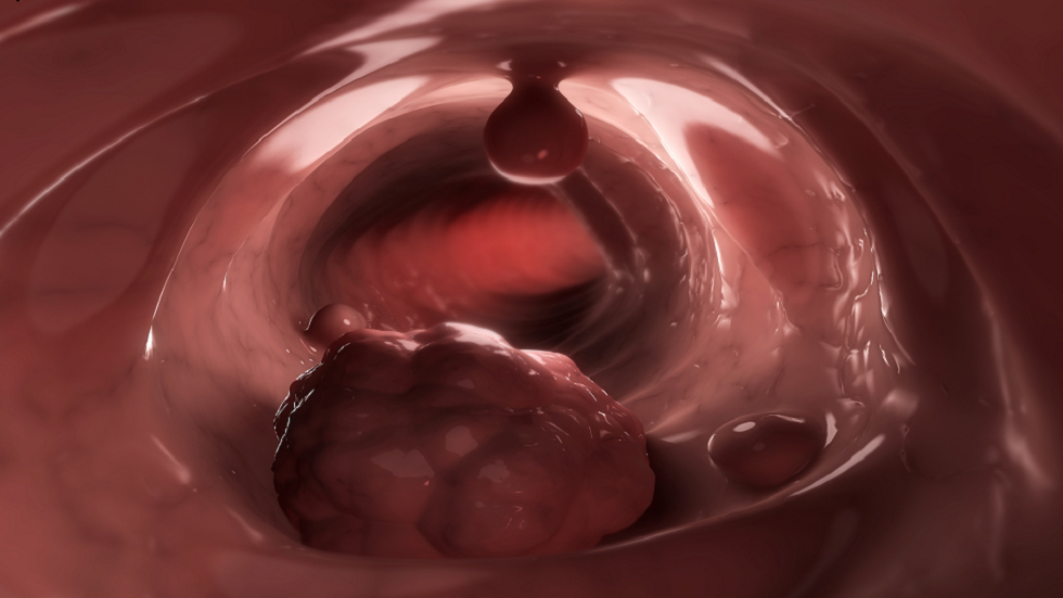 مشروب شائع ثبت أنه يزيد من خطر الإصابة بسرطان الأمعاء بـ