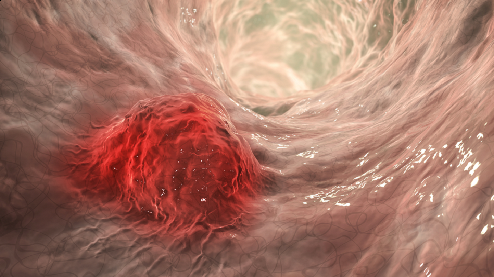 دراسة: كلما طالت مدة زيادة الوزن أو السمنة زادت فرص الإصابة بسرطان خطير!