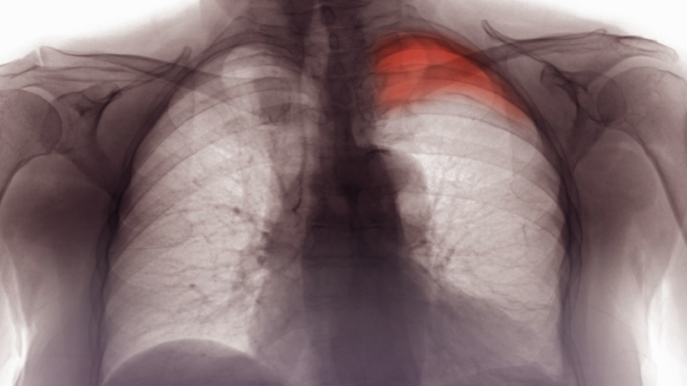 دراسة: مركب نباتي يمكن أن يقلل من خطر إصابة الرئة من 