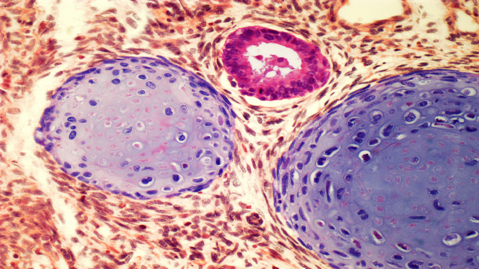 تورم في الخصية وعلامات أخرى للسرطان يجب معرفتها