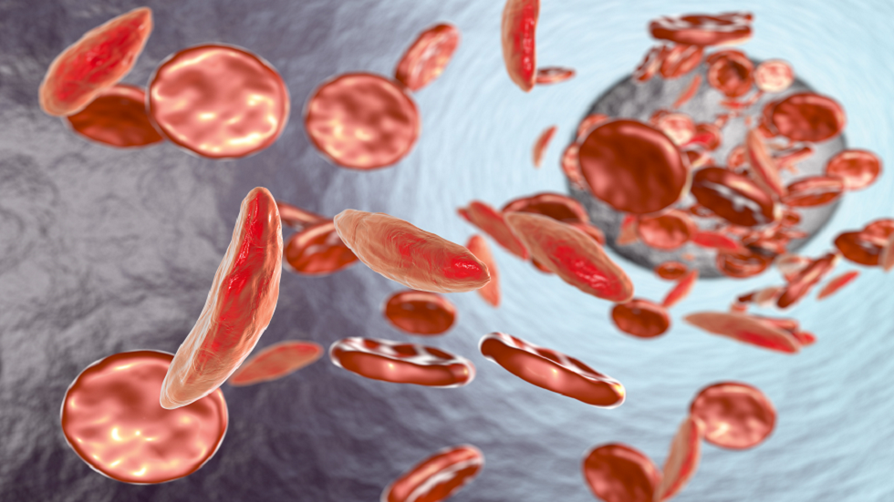 5 علامات جسدية منبهة لفقر الدم