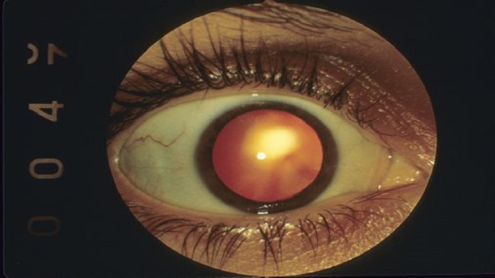 قاع العين للتنبؤ بأمراض القلب والأوعية الدموية
