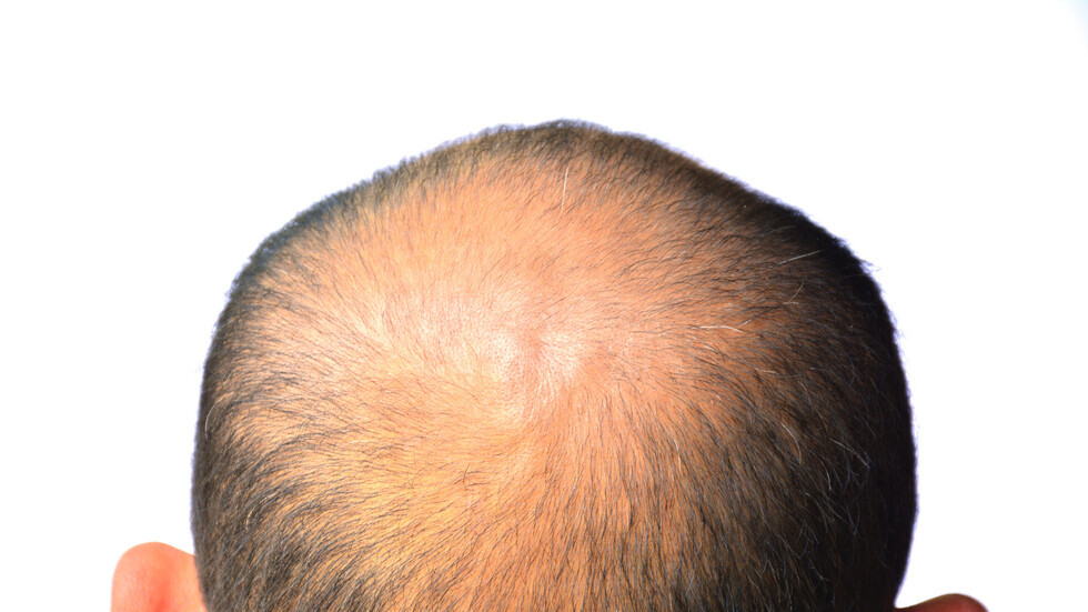 دواء جديد لاستعادة الشعر بالكامل لدى المصابين بمرض مناعي يسبب الصلع