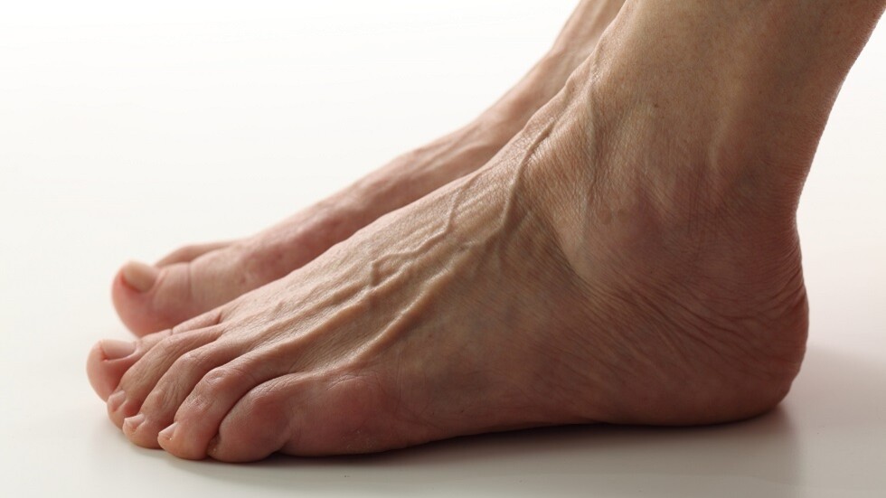 الحاجة إلى جراحة الدوالي مرتبطة بالوراثة