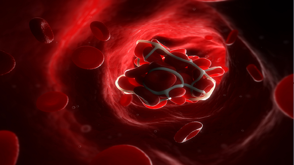 أعراض تجلط الدم: علامة في سعالك يمكن أن تشير إلى انسداد رئوي