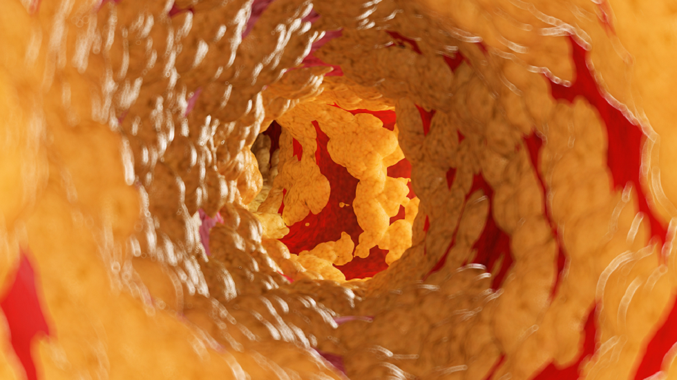 علامة تحذير خفية لارتفاع الكوليسترول يعتقد الناس أنها 