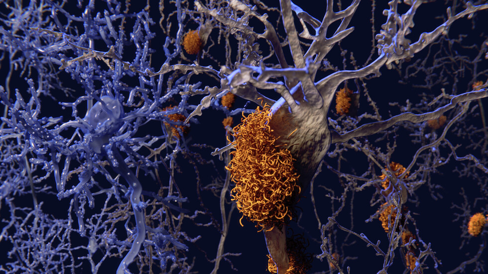 العلماء يكشفون عن أدلة جديدة على الآلية الرئيسية في مرض ألزهايمر