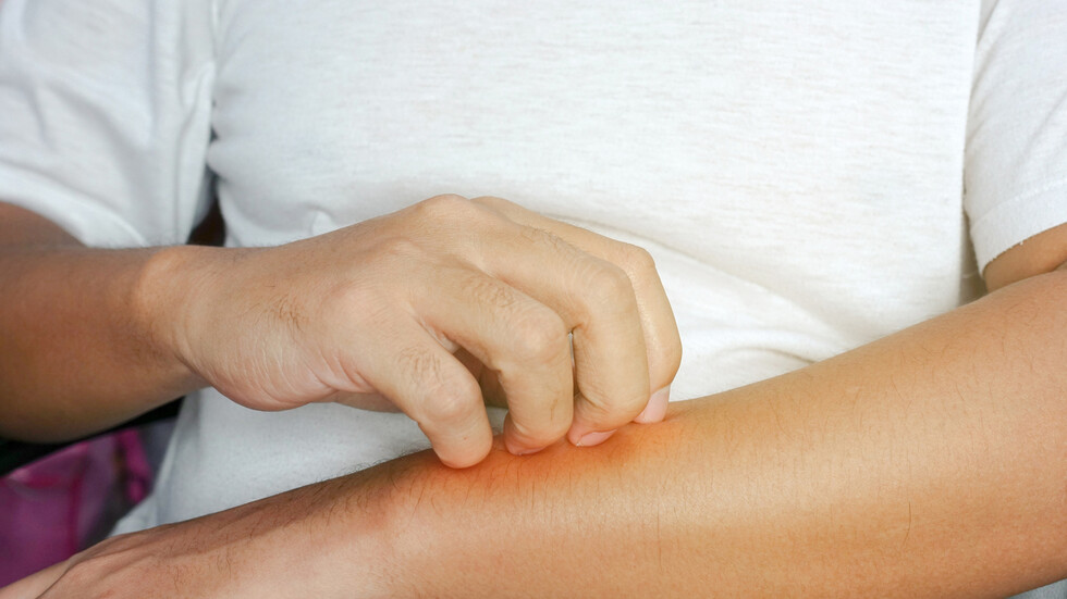 لماذا تسبب لدغات الحشرات حكة ومتى يكون الأمر مقلقا؟