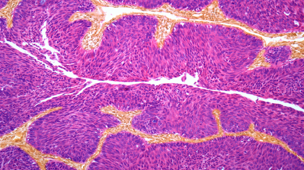 الموافقة على دواء جديد يمكنه تغيير حياة مرضى سرطان المثانة!