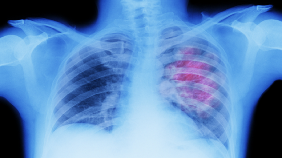 الأطباء يكشفون عارضين أساسيين لسرطان الرئة
