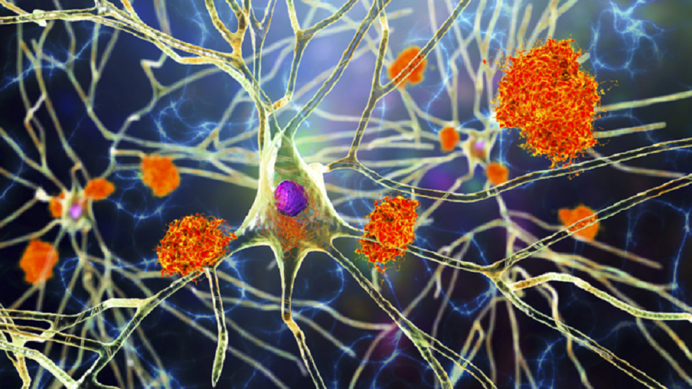 إثبات العلاقة بين نمط الحياة غير الصحي و خطر الإصابة بالخرف