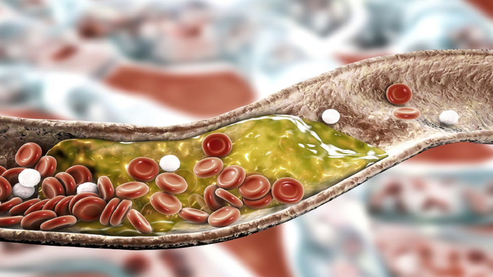 جفاف الجلد في منطقة محددة قد يكون علامة على ارتفاع مستويات الكوليسترول