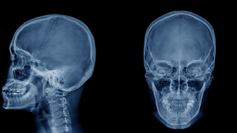 هل يمكن لإصابة الارتجاج المتكررة أن تجعل الجمجمة أكثر سمكا؟