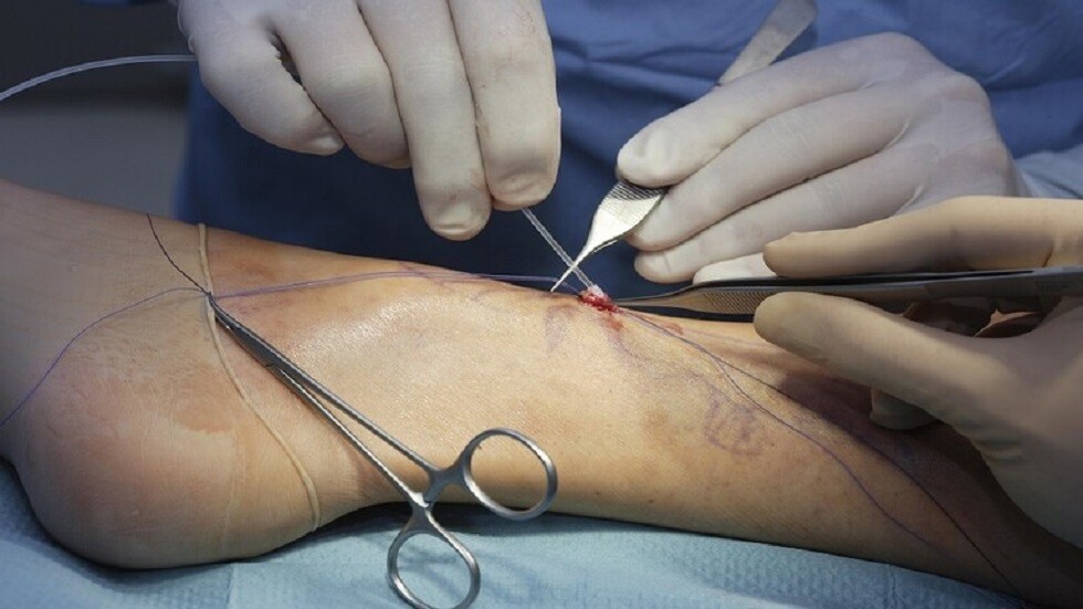 طبيب روسي يوضح كيف يمكن تجنب تجلط الأوردة العميقة