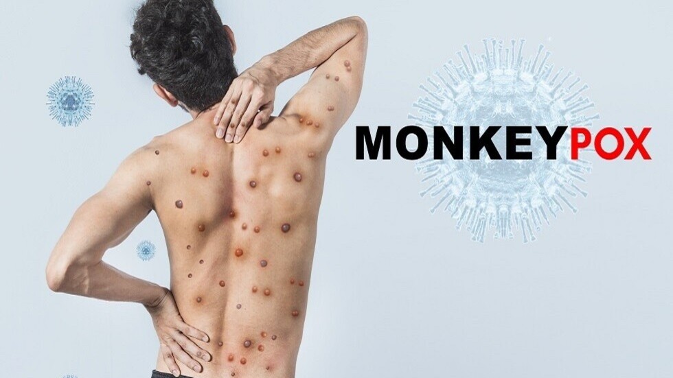 تسجيل أول  إصابة بفيروس جدري القردة في أوكرانيا