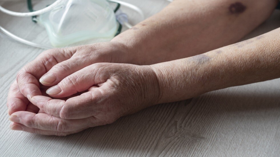 الأطباء يكشفون أسباب غير متوقعة للكدمات