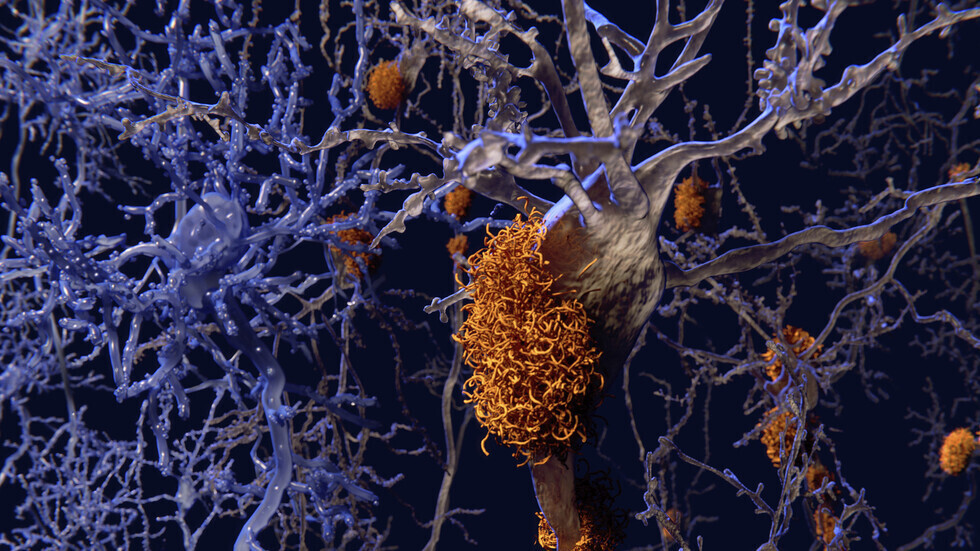 عقار ألزهايمر 