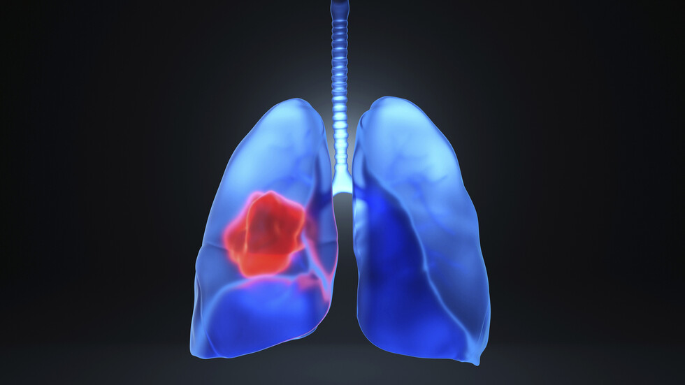 أحدها يظهر على الأظافر.. أعراض مفاجئة لسرطان الرئة الفتاك يجب ألا نتجاهلها