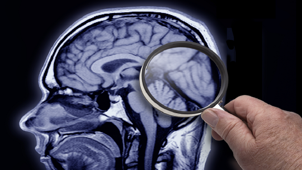 اكتشاف جديد يمكن أن يفسر الغموض المتعلق بمرض الزهايمر