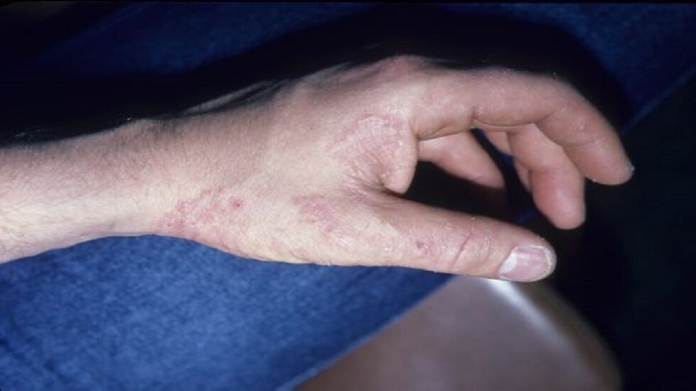 طبيب روسي يكشف المكان الأخطر لانتقال عدوى الفطريات