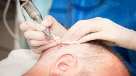 دخل لإجراء عملية زرع شعر فخرج جثة هامدة (صور)