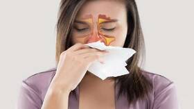 طبيب روسي يكشف طرق علاج التهاب الجيوب الأنفية
