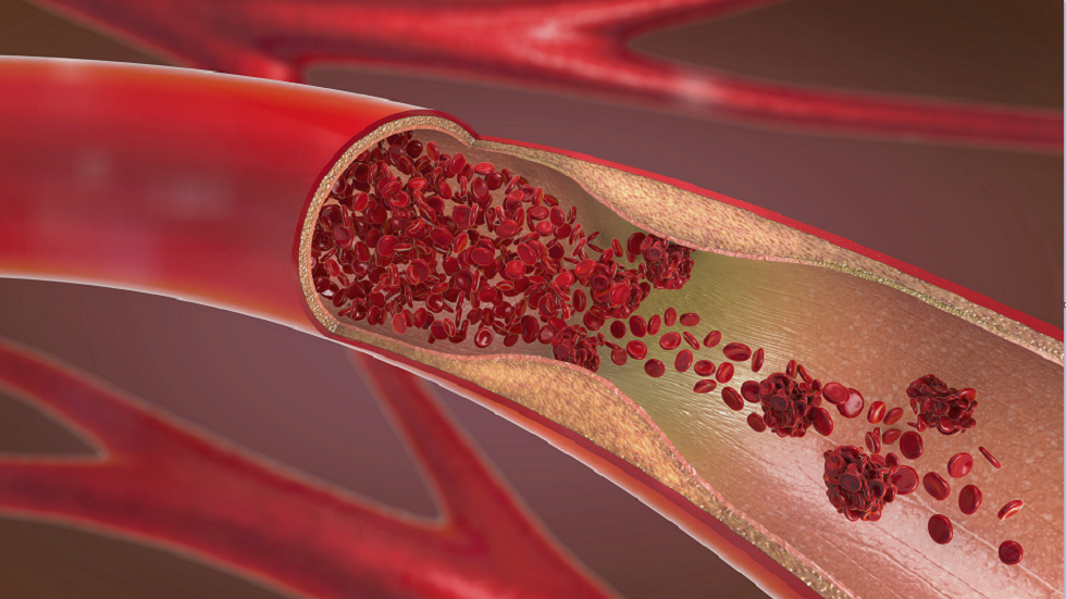 لأول مرة.. اكتشاف لدائن دقيقة مستخدمة في تغليف المواد الغذائية في الأوردة البشرية!