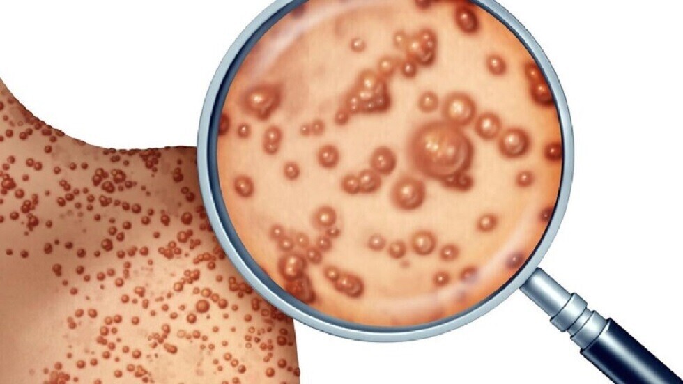 الصحة العالمية تمدد حالة الطوارئ الصحية عالميا بسبب "جدري القردة"