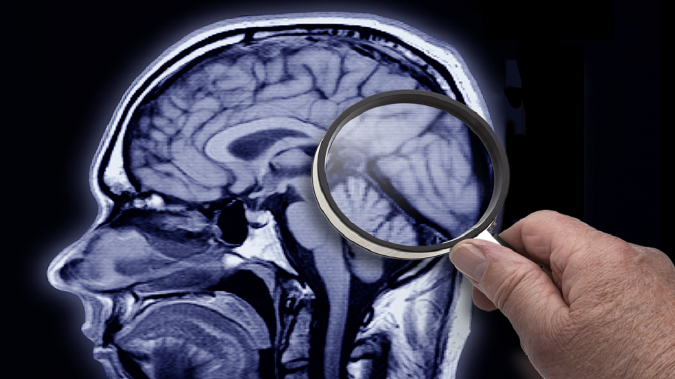 أطباء أعصاب يشخّصون أصغر حالة من مرض ألزهايمر 
