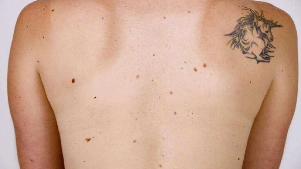 طبيبة روسية تكشف مخاطر الشامات الحمراء