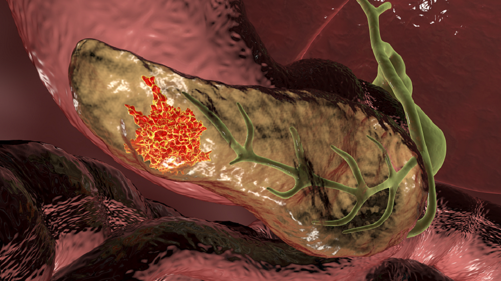 دراسة تكشف عن اثنين من الأعراض الأقل شهرة لسرطان البنكرياس!