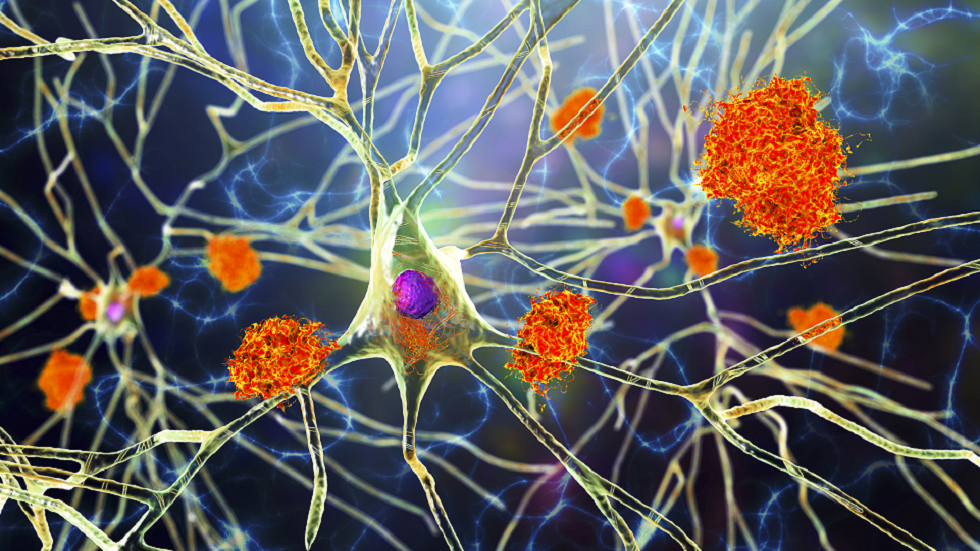 تحديد طفرة نادرة لدى رجل تحمي من مرض الزهايمر!