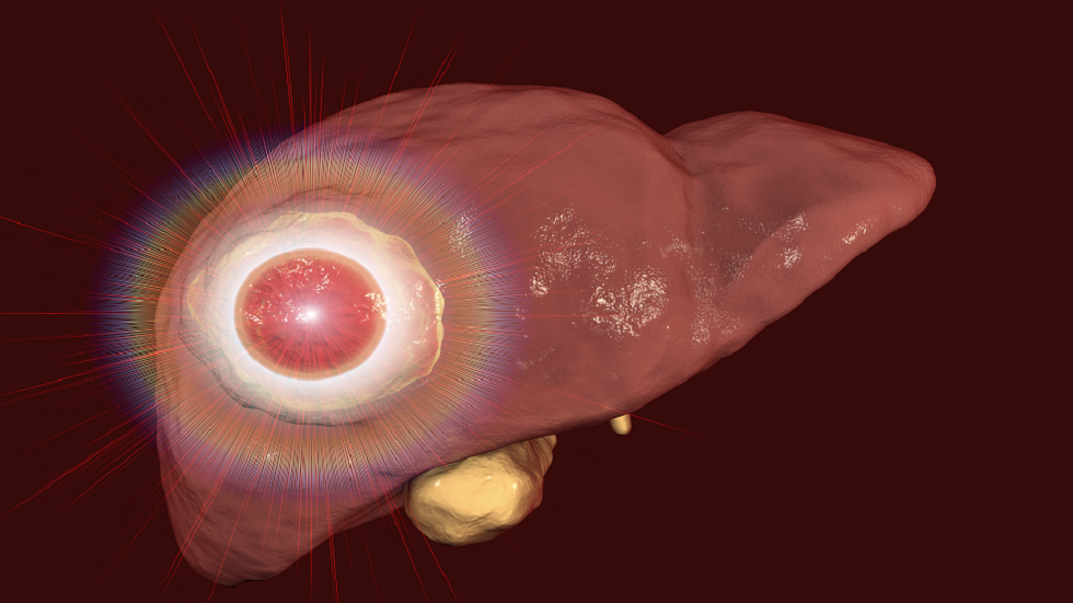 ثلاث علامات في بطنك يمكن أن تكشف إصابة سرطان الكبد!