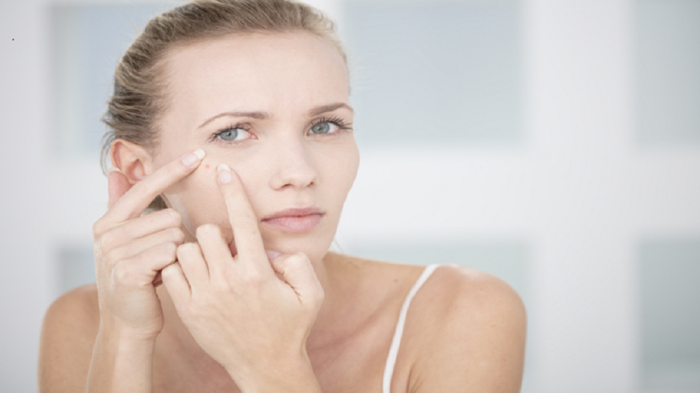 طبيبة توضح سبب ظهور حب الشباب لدى البالغين