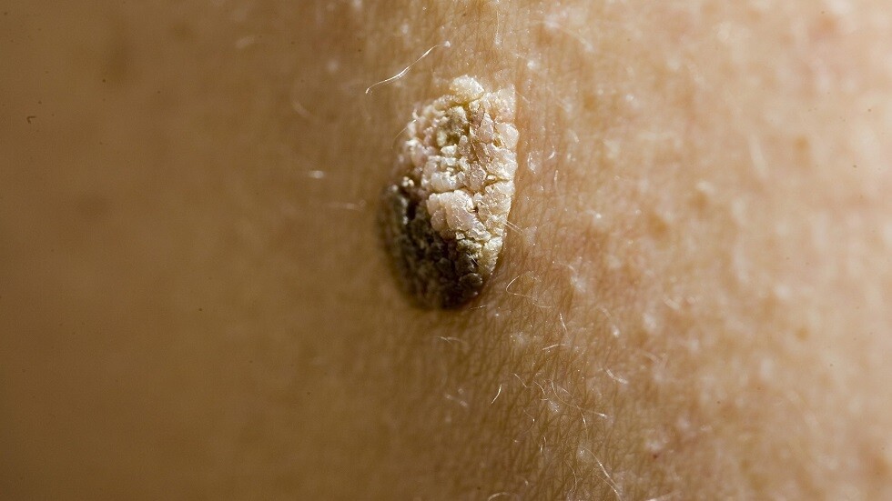 طبيبة توضح ما إذا كان لون الورم الحليمي يساعد على تشخيص السرطان