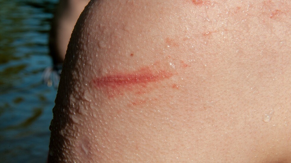 علماء روس يبتكرون مادة تسرع التئام الجروح بنسبة 30 بالمئة