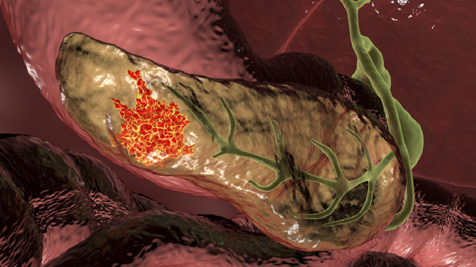 علامة هامة لسرطان البنكرياس تظهر في 86% من الحالات!