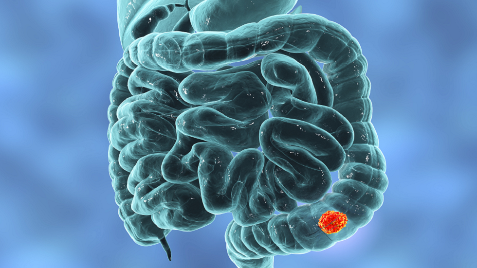 مريضة سرطان تنشر الوعي بعد تجاهل الأطباء أعراضها!