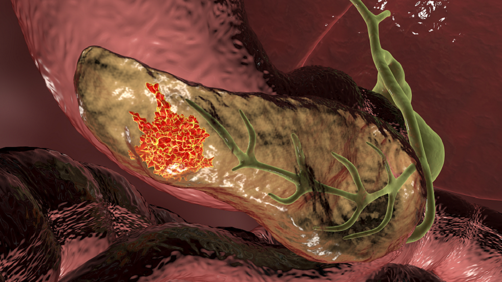 كيف يمكن الخلط بين سرطان البنكرياس وحالات أخرى؟!