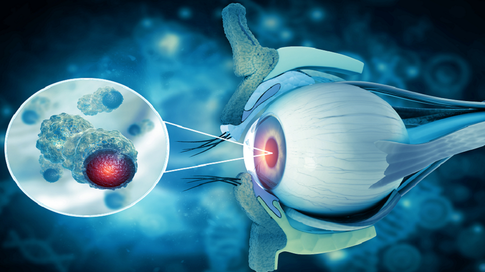 العلامات الأولى لسرطان العين الأكثر شيوعا!