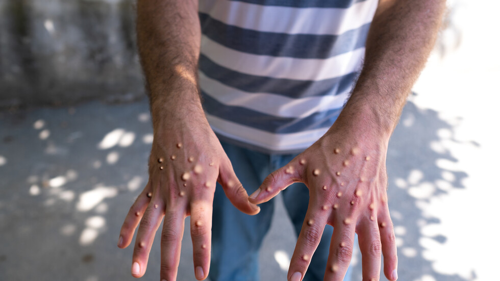 منظمة الصحة العالمية تحذر من تزايد الإصابات بفيروس امبوكس "جدري القردة" في دولة إفريقية