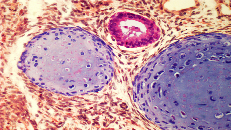 احذر "رئة المدفع" المميتة جراء عدم فحص الخصيتين ذاتيا!