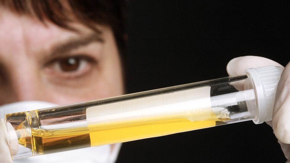 اكتشاف السبب المسؤول عن "لون البول" في جسم الإنسان