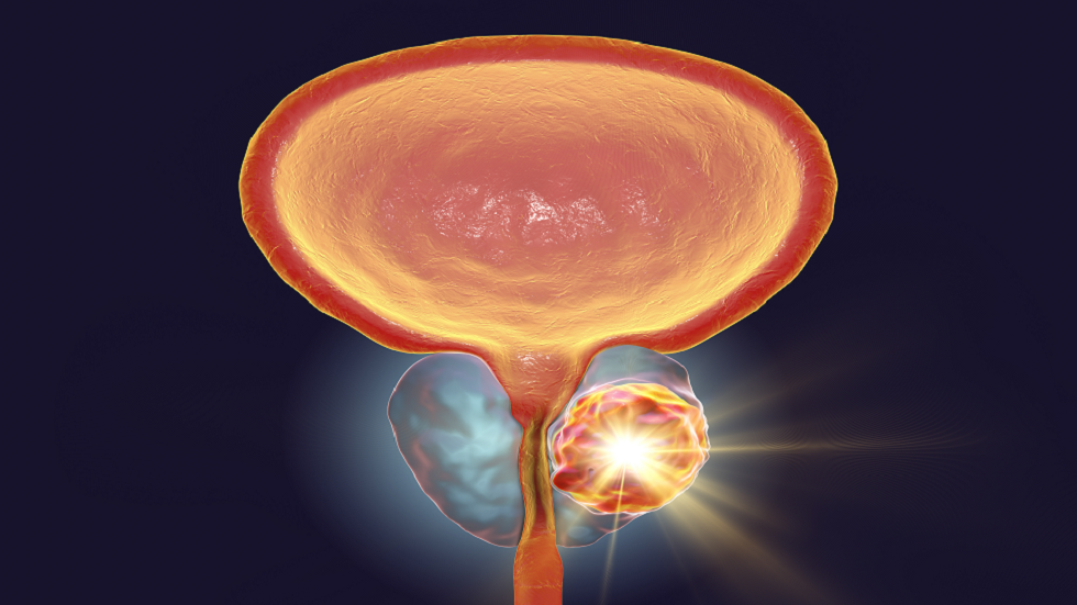 كيف يمكن للرجال خفض احتمالات إصابتهم بسرطان البروستات؟