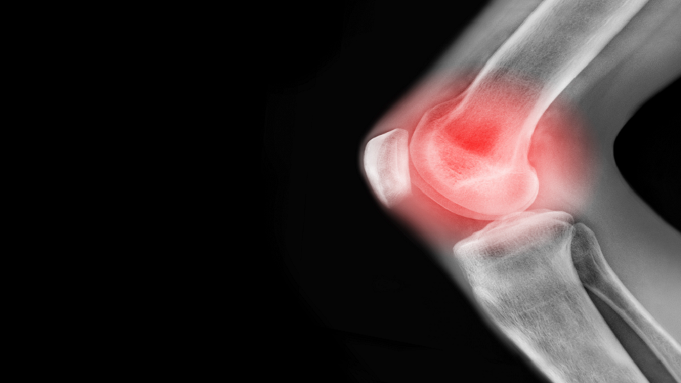 "اختراق طبي" قد يضع نهاية لالتهاب المفاصل الروماتويدي