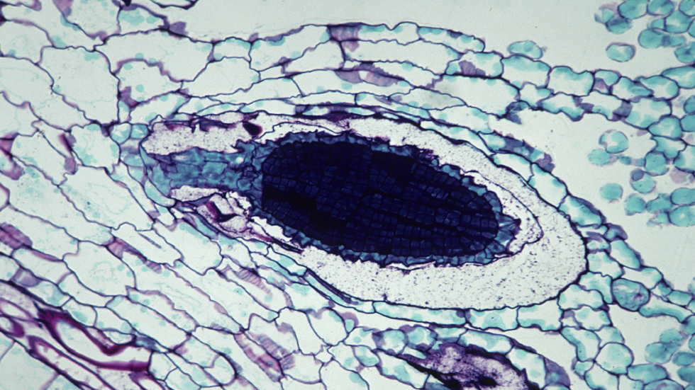 دراسة : السرطان يهدد حياة أطفال الرجال الذين يعانون من ضعف الخصوبة